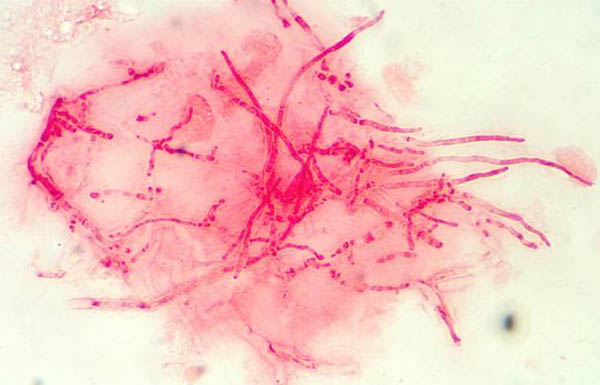 corneal aspergillosis