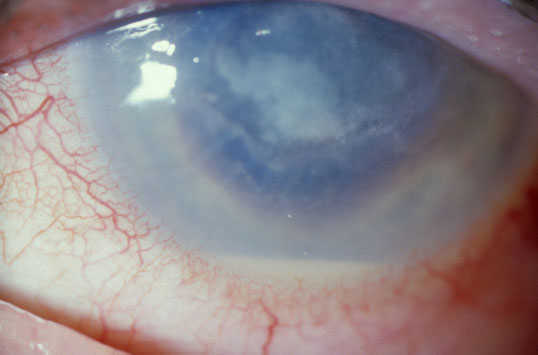 herpes simplex keratitis. Aspergillus Keratitis