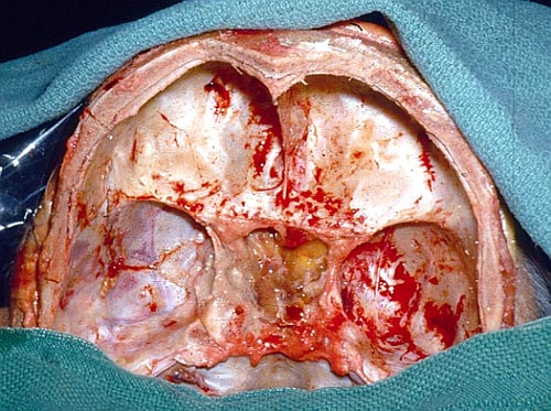 aspergillus sinusitis