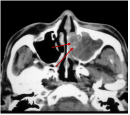 sinual mri 