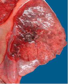 Fungal mold  ball in the lung of patient.