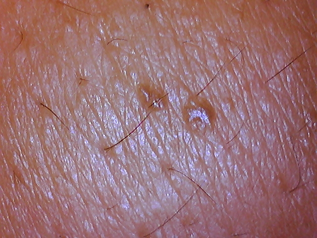 morgellons